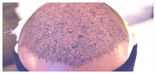 أحدث طرق زراعة الشعر